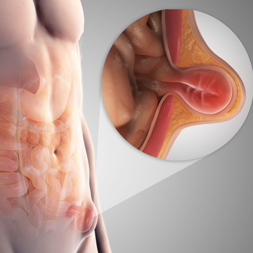 cirgherniainguinal 1