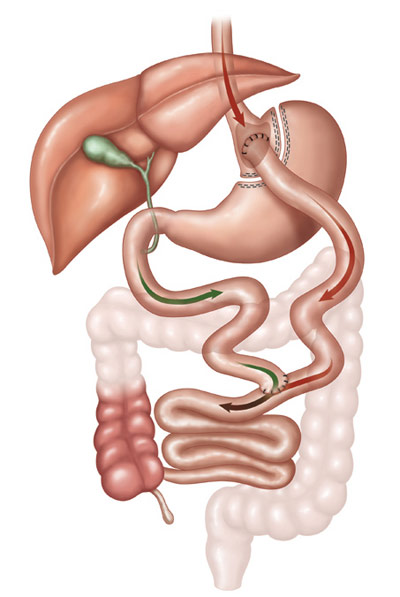 gastric bypass